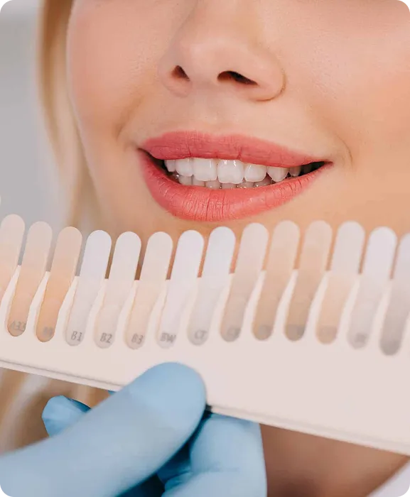 Close-up of a smiling mouth with teeth matched to a dental shade guide held by a gloved hand.