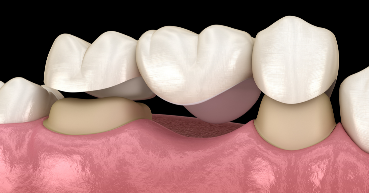 Are Dental Bridges Permanent?