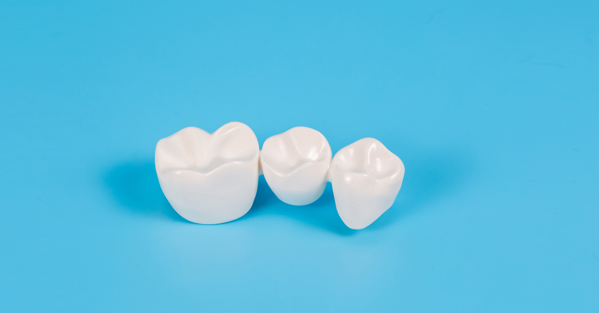 Are Dental Bridges Worth It?