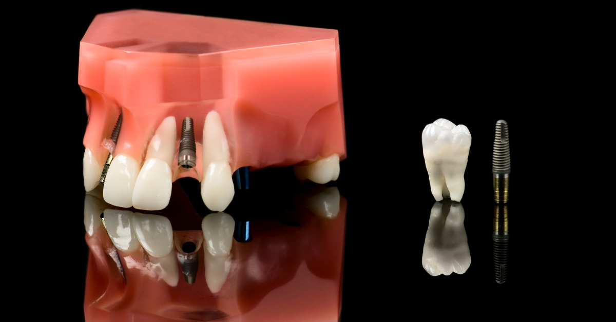 Are Dental Implants Necessary After Extraction?