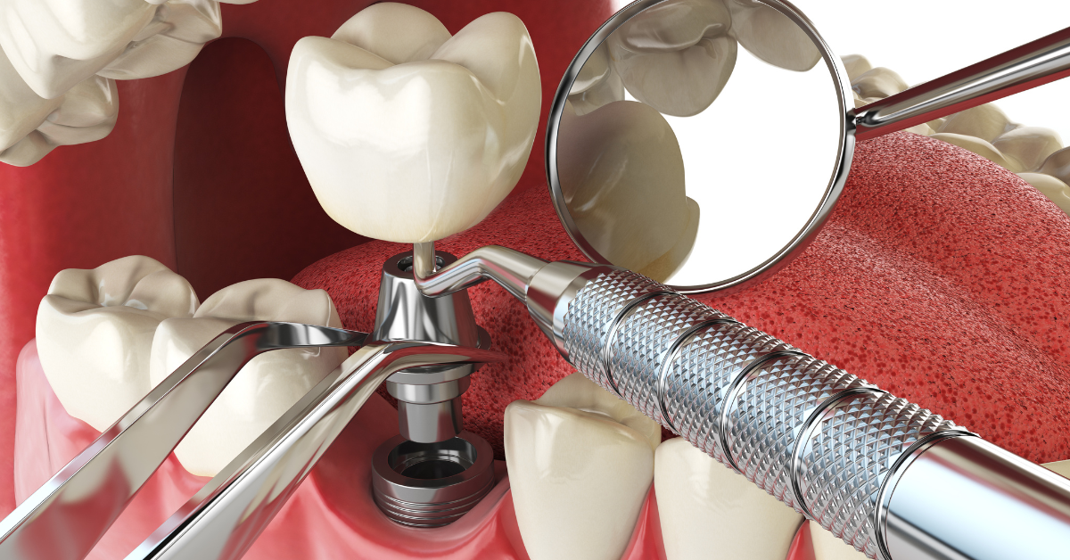 Are Dental Implants Safe?