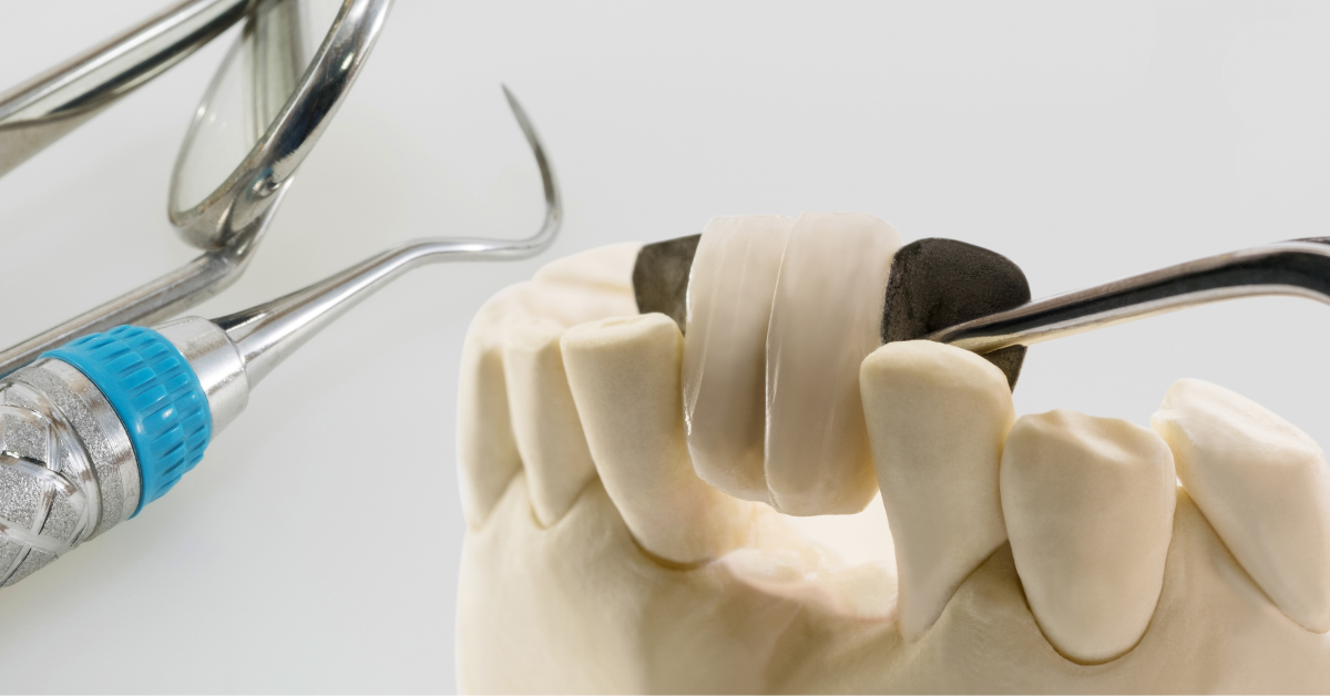 Can A Dental Bridge Be Adjusted?
