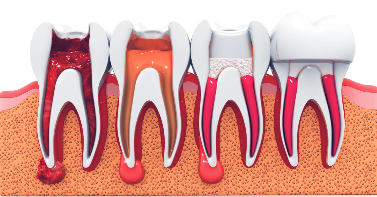 Can An Abscess Come Back After Root Canal?