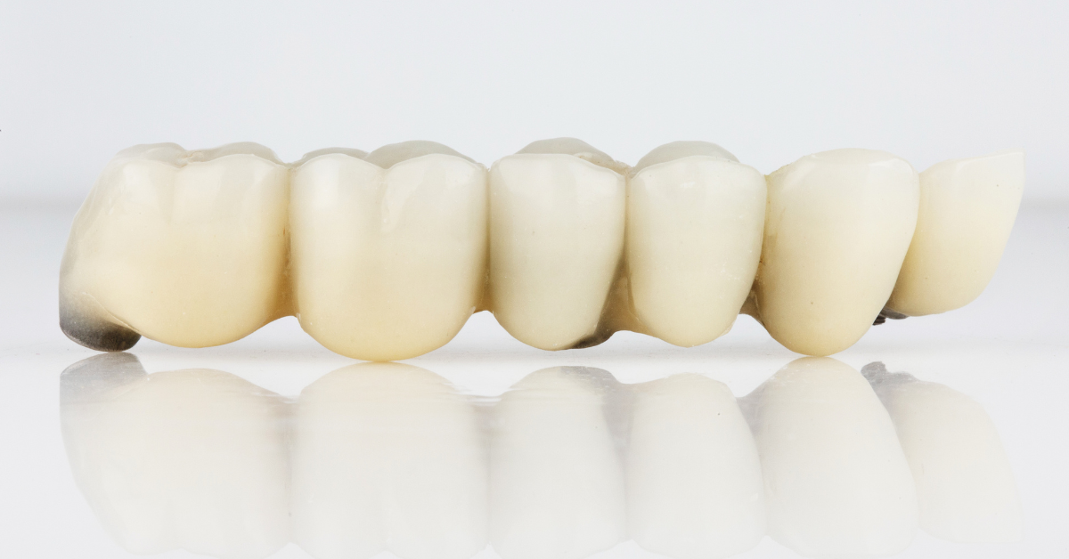 Can a dental bridge be done in one day?