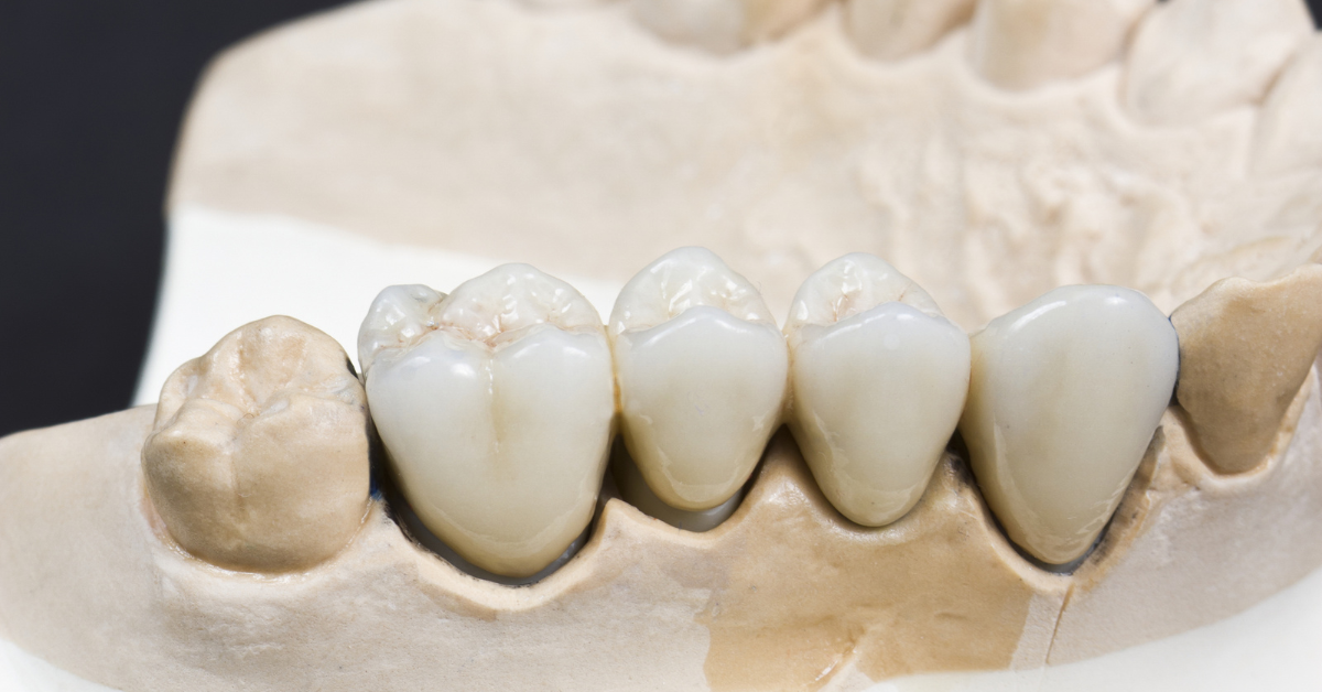 Can a dental bridge be removed and recemented?