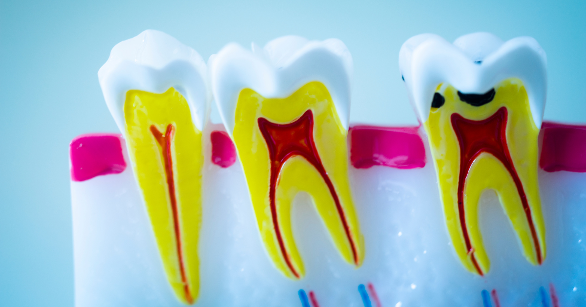 Can you get a crown without a root canal?