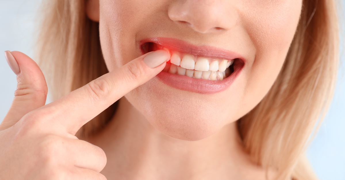 Do Gums Bleed During Scaling And Root Planing?