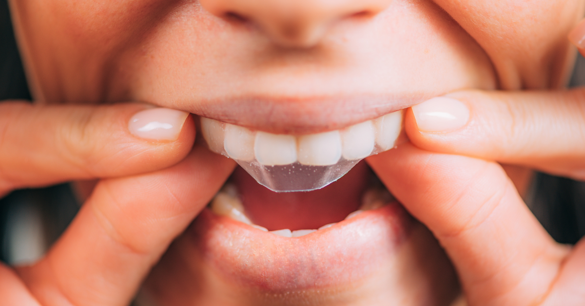 Do You Brush Your Teeth After Whitening Strips?
