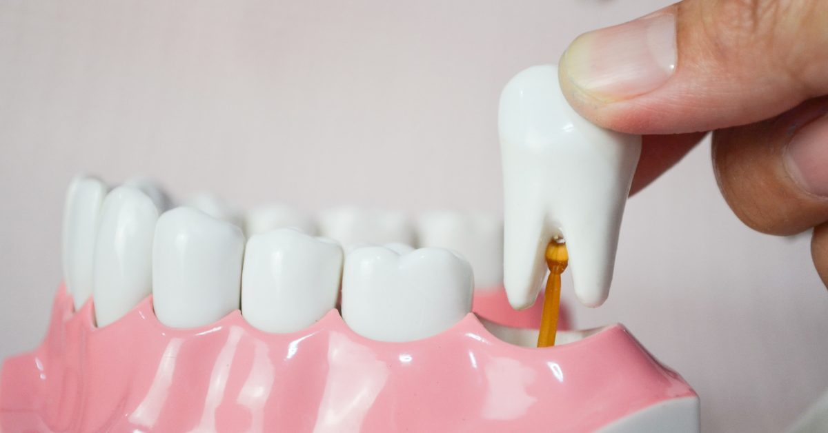 Do dental plans cover wisdom teeth extractions?
