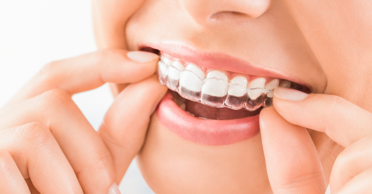 How Long Does Invisalign® Treatment Take?