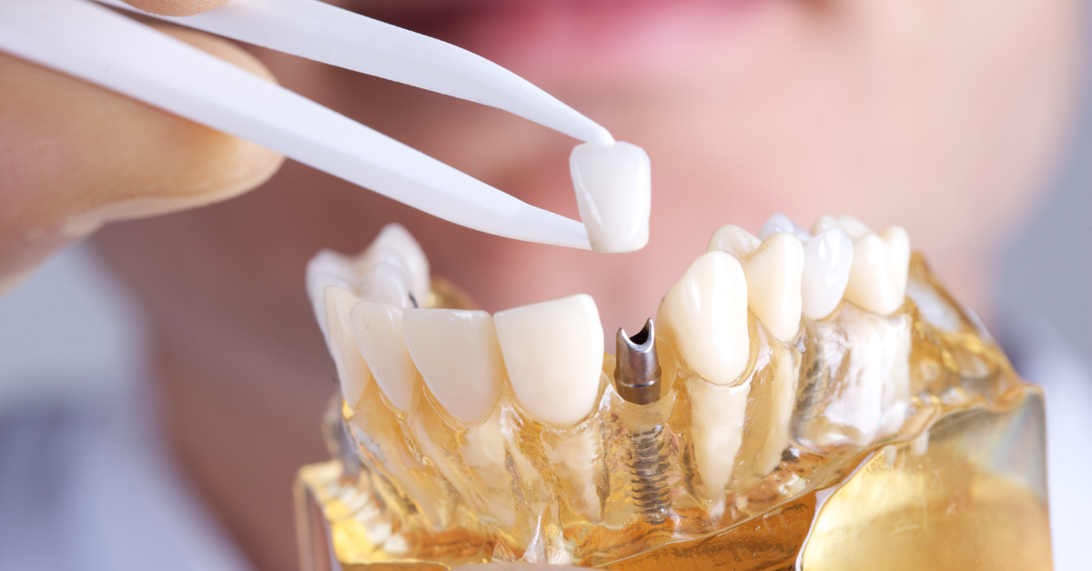 How do dental implants work?