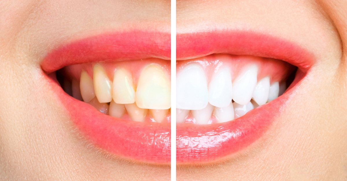 How long after teeth whitening can I drink coffee?
