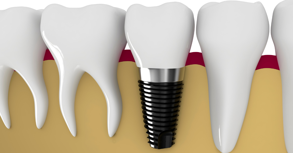 How long does a dental implant procedure take?
