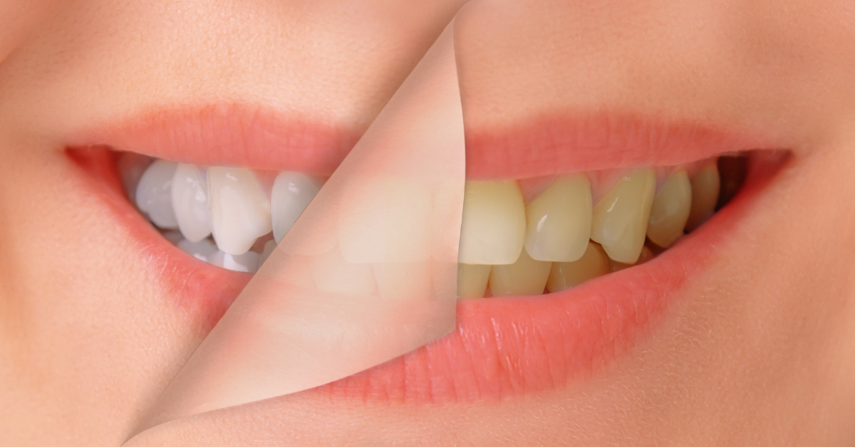 Is Teeth Whitening Safe?