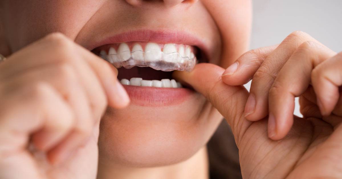 What Are The Primary Benefits Of Invisalign®?