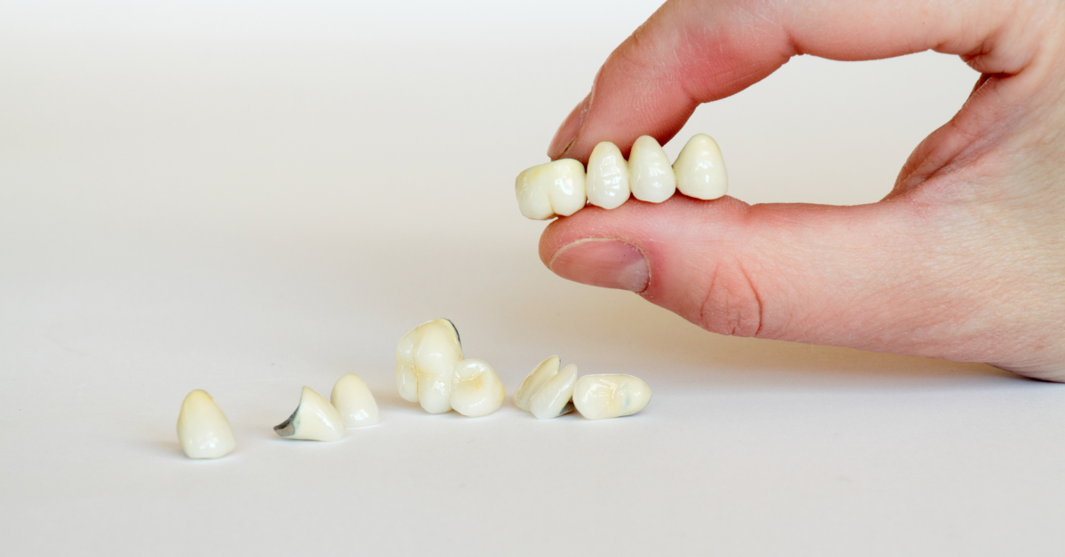 What Is A Dental Bridge?