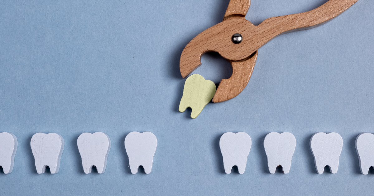 What Is A Dental Extraction?