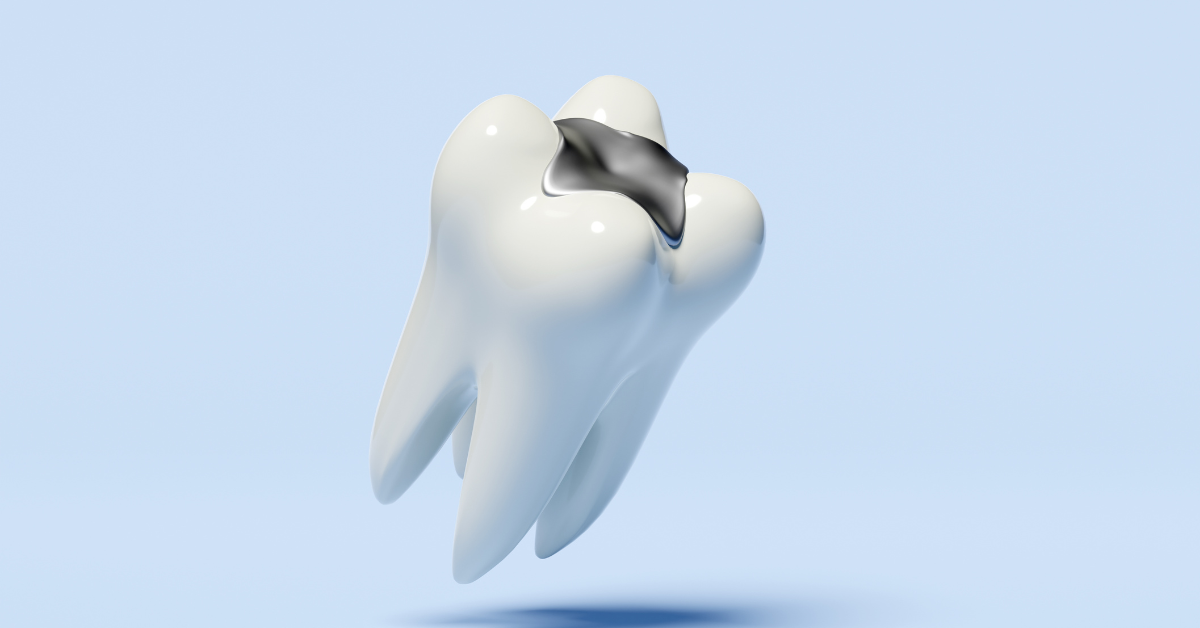What Is A Dental Filling?