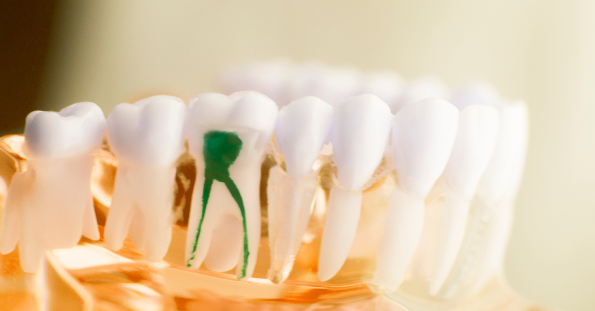 What To Eat After Root Canal?
