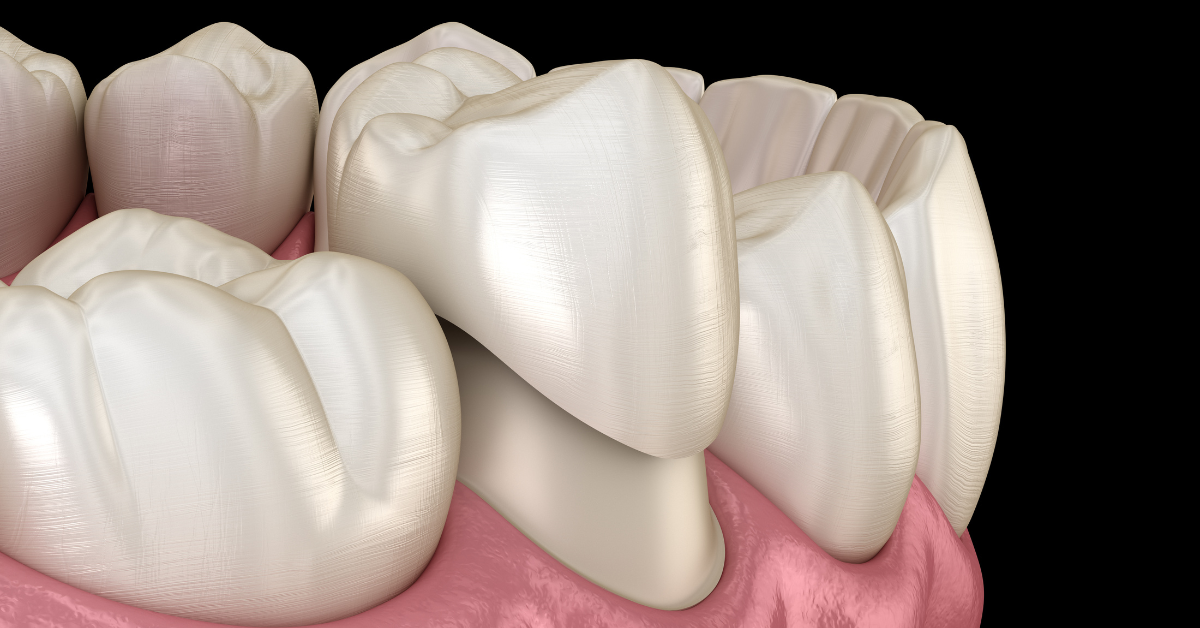 When Would You Need A Dental Crown?