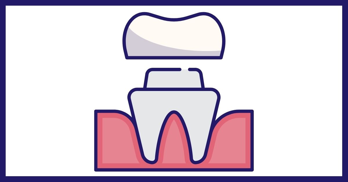 When would you need a dental crown?