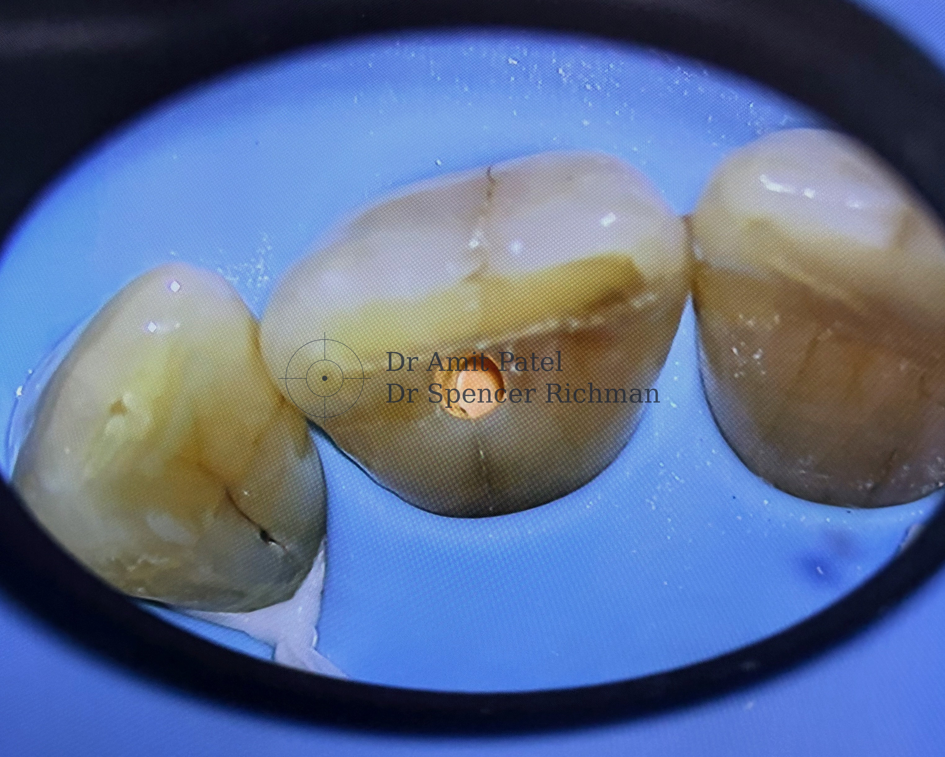 Guided endodontics clinical case