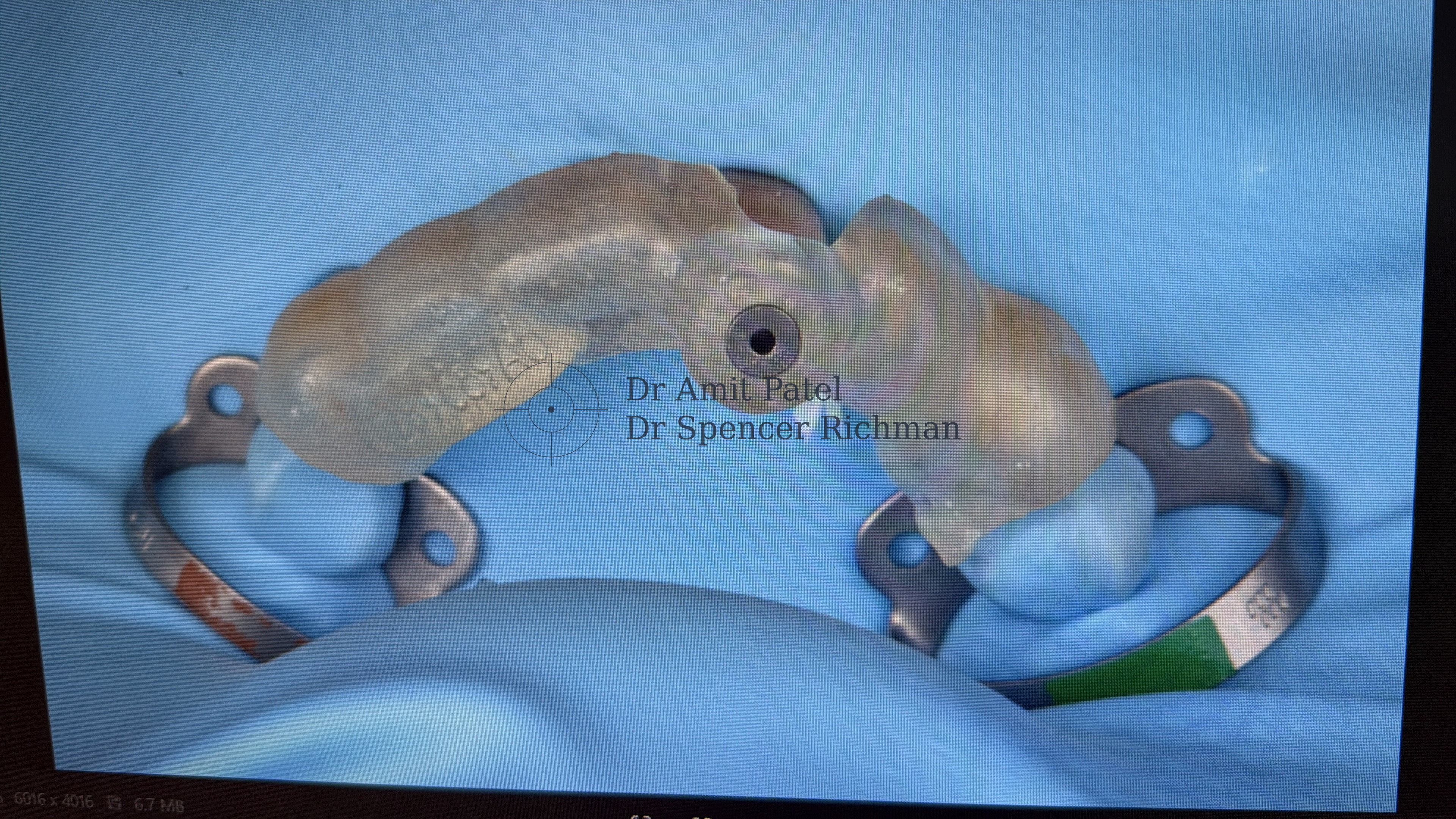 Guided endodontics clinical case