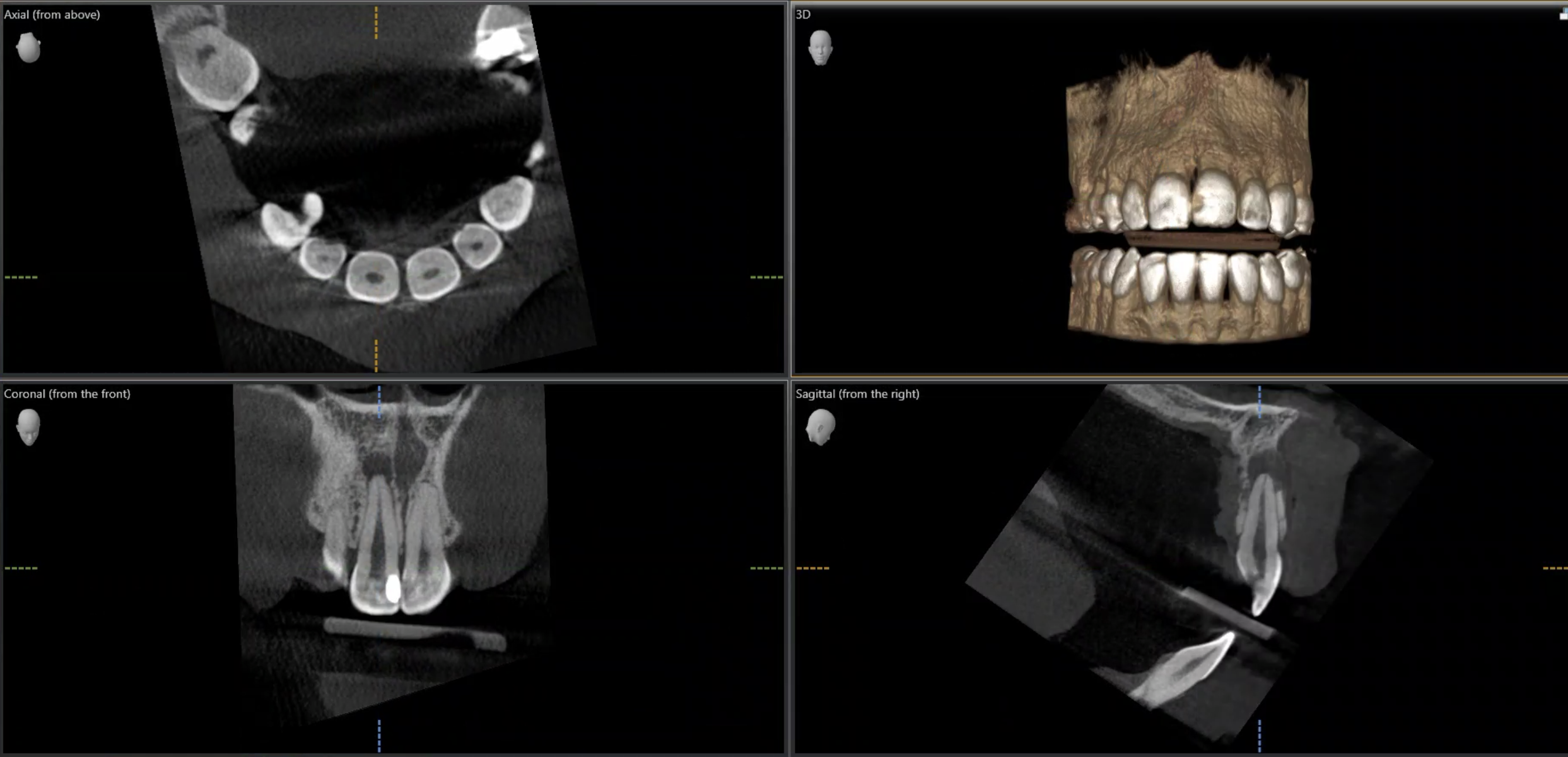 CBCT scan showing a tooth root and surrounding bone in axial, 3D, coronal and sagittal views