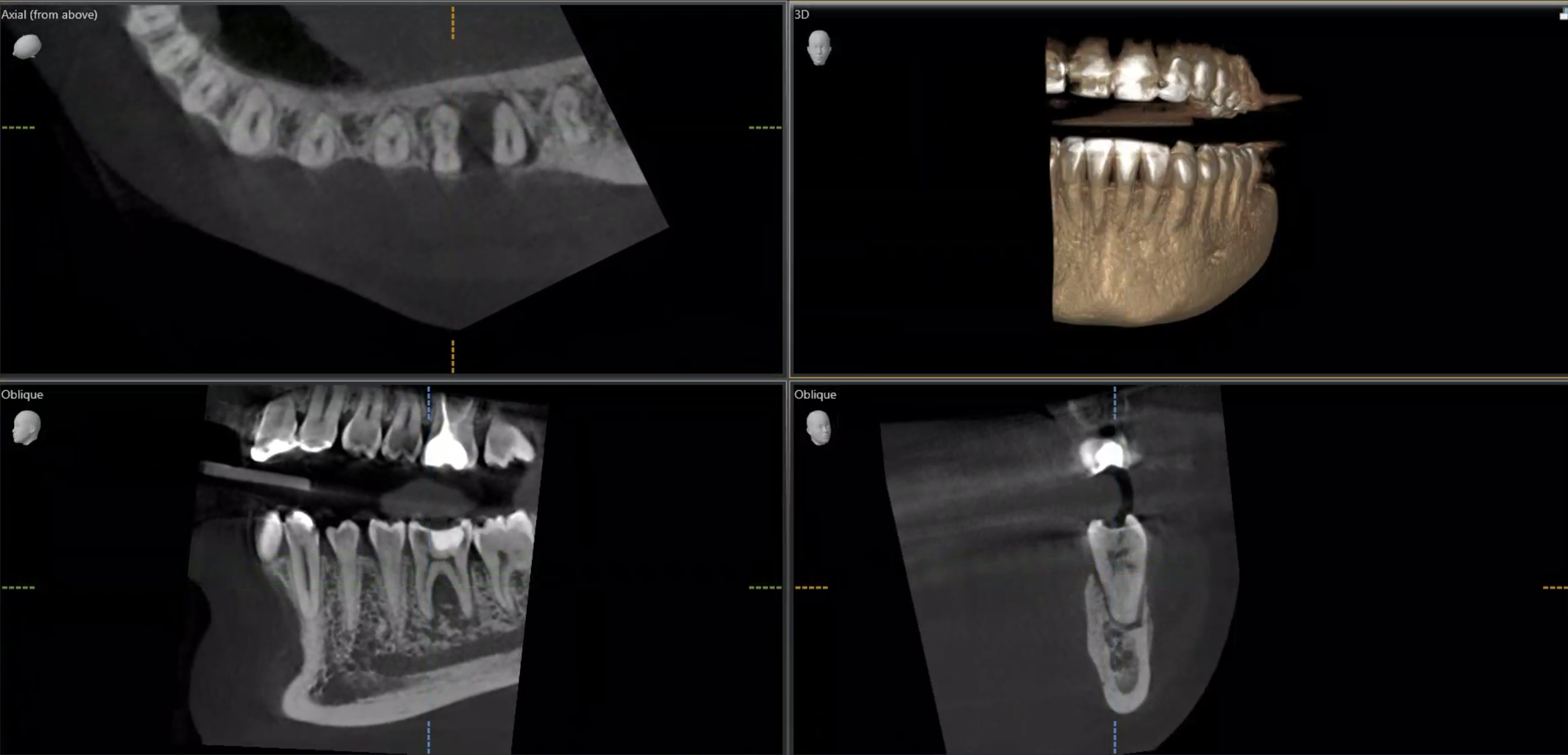 CBCT before root canal treatment showing infection and bone loss at the tooth root