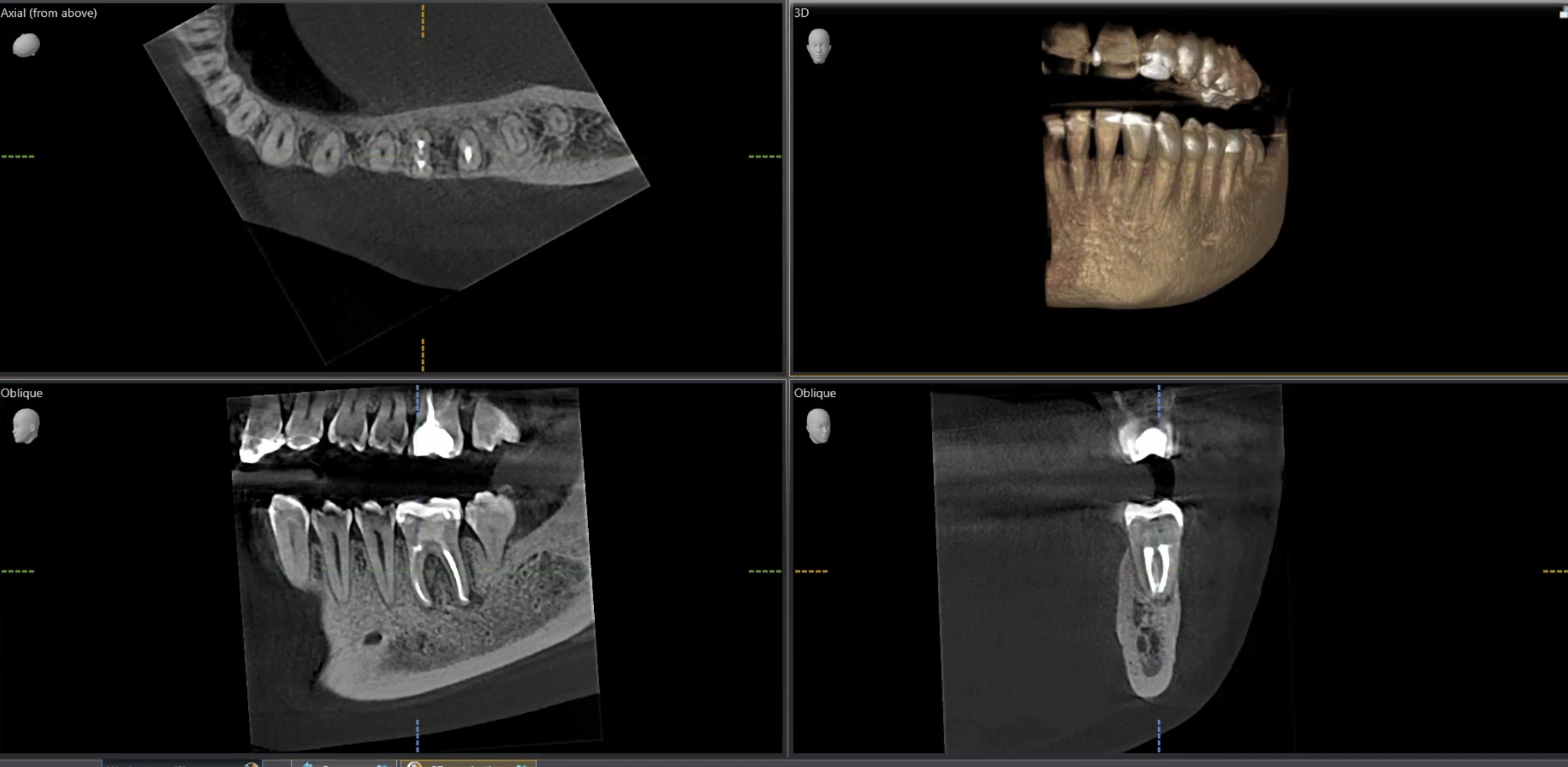 CBCT after root canal treatment showing healing of the infection and recovery of the surrounding bone