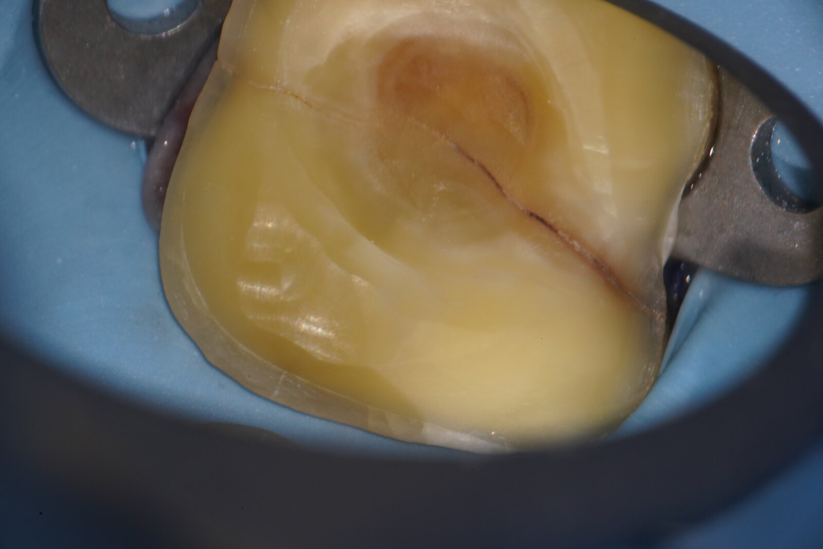 A cracked molar isolated under a dental operating microscope, with a stained fracture line running across the tooth