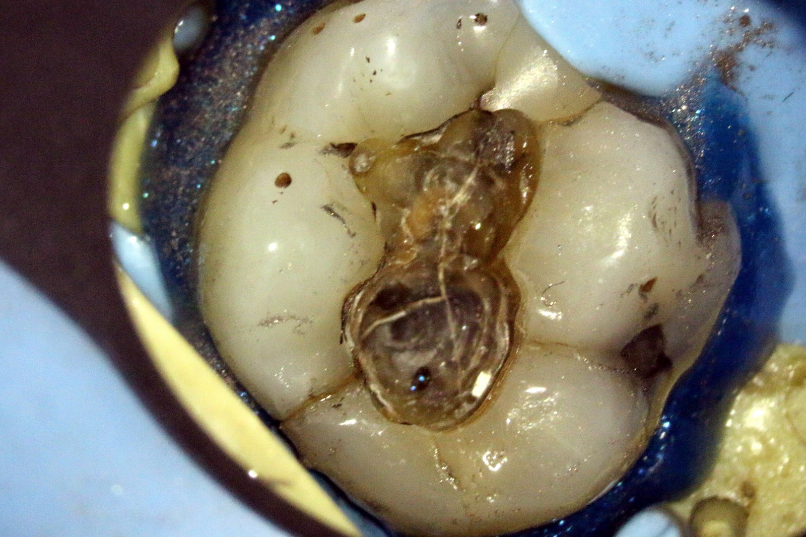 A cracked molar under the dental operating microscope with an old filling removed, the fracture line running across the tooth