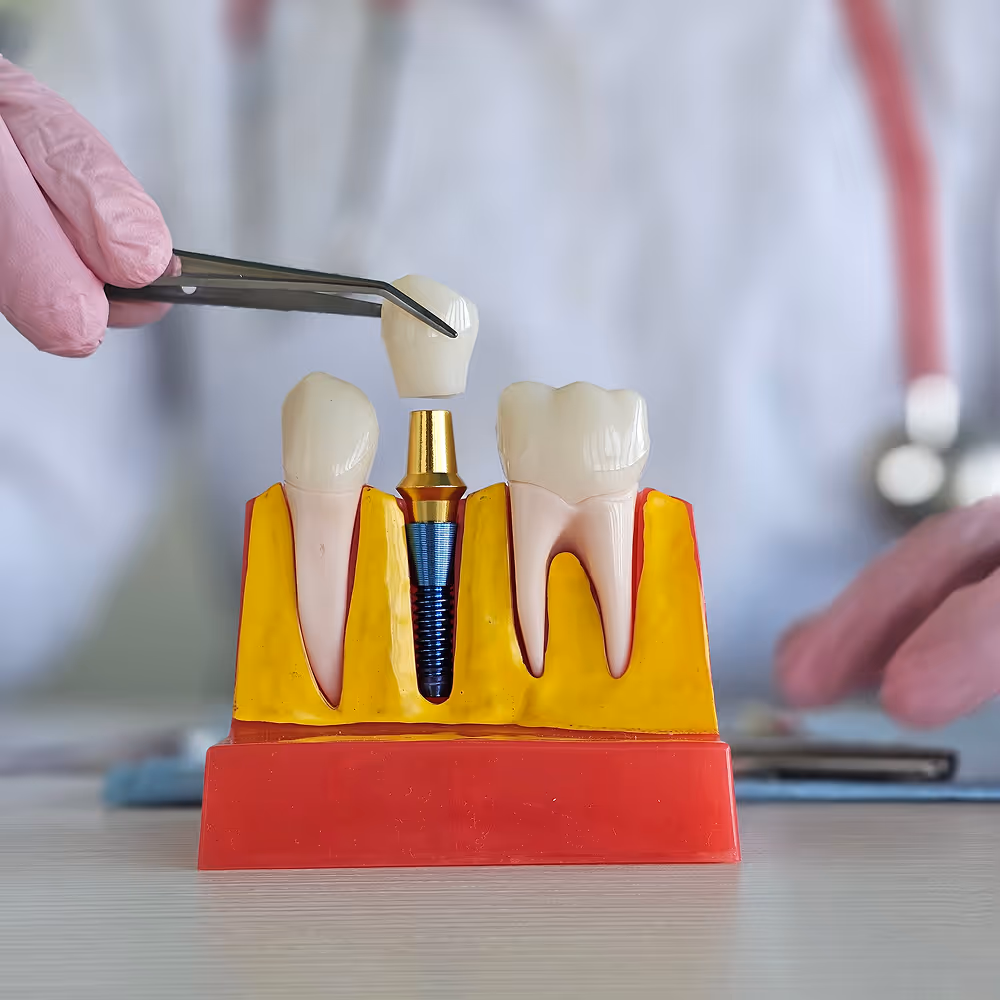 A titanium implant post fused with the jawbone, supporting a crown