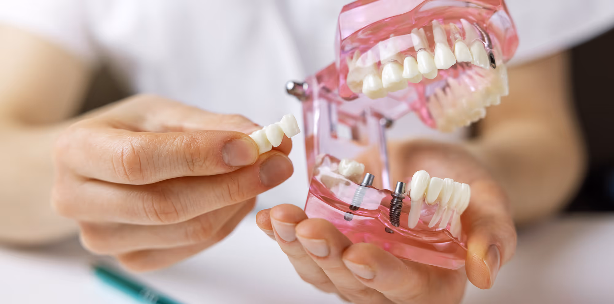 An implant bridge replacing several missing teeth in a row