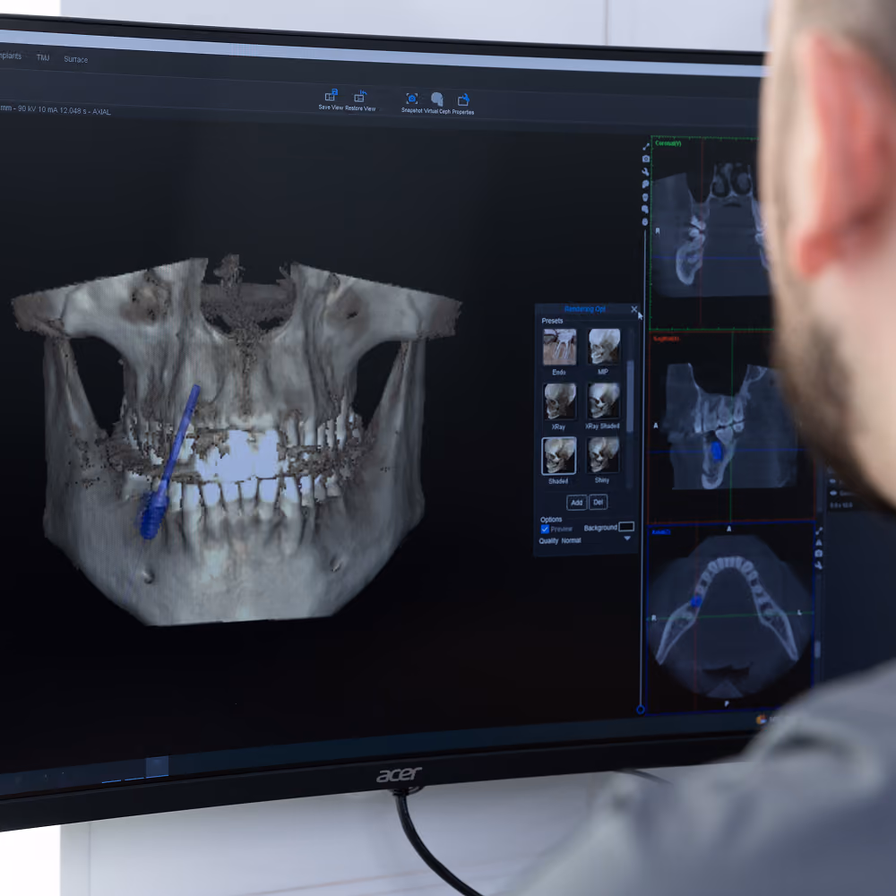 3D dental scan displayed in implant planning software at Restore Dental Implant Studio
