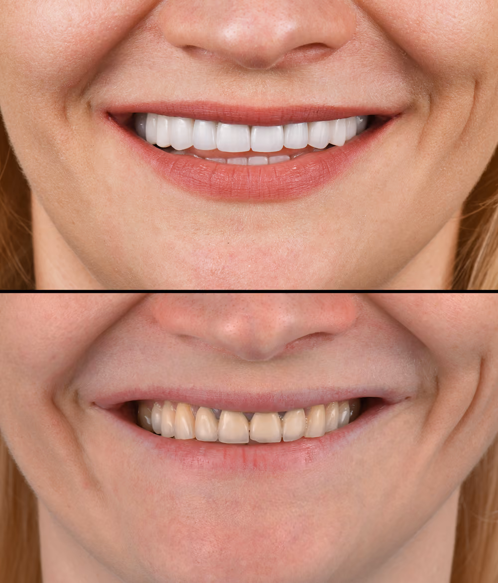 Close-up before and after of implant-supported teeth with natural shape and color
