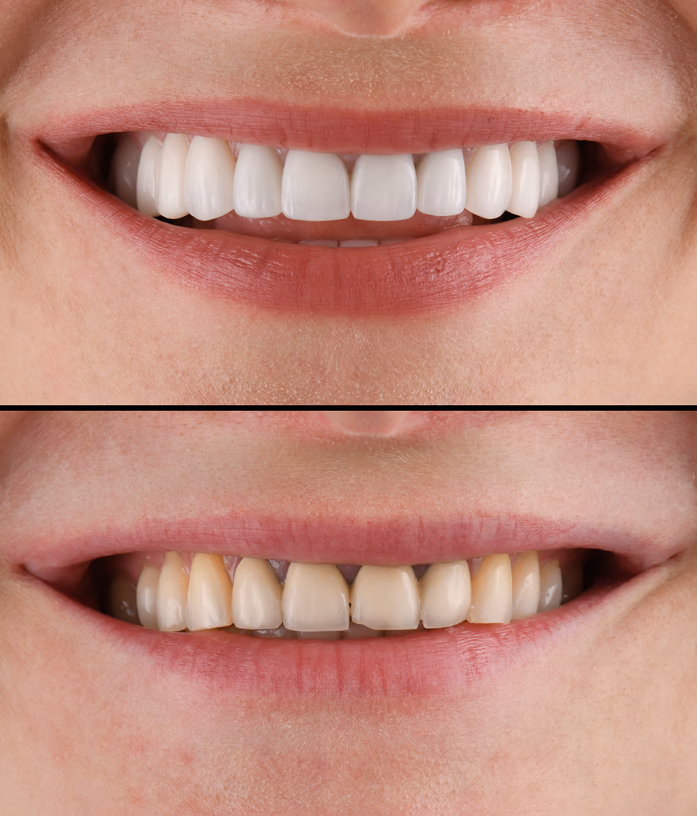 Before and after of a full-arch implant reconstruction at Restore Dental Implant Studio in Las Vegas