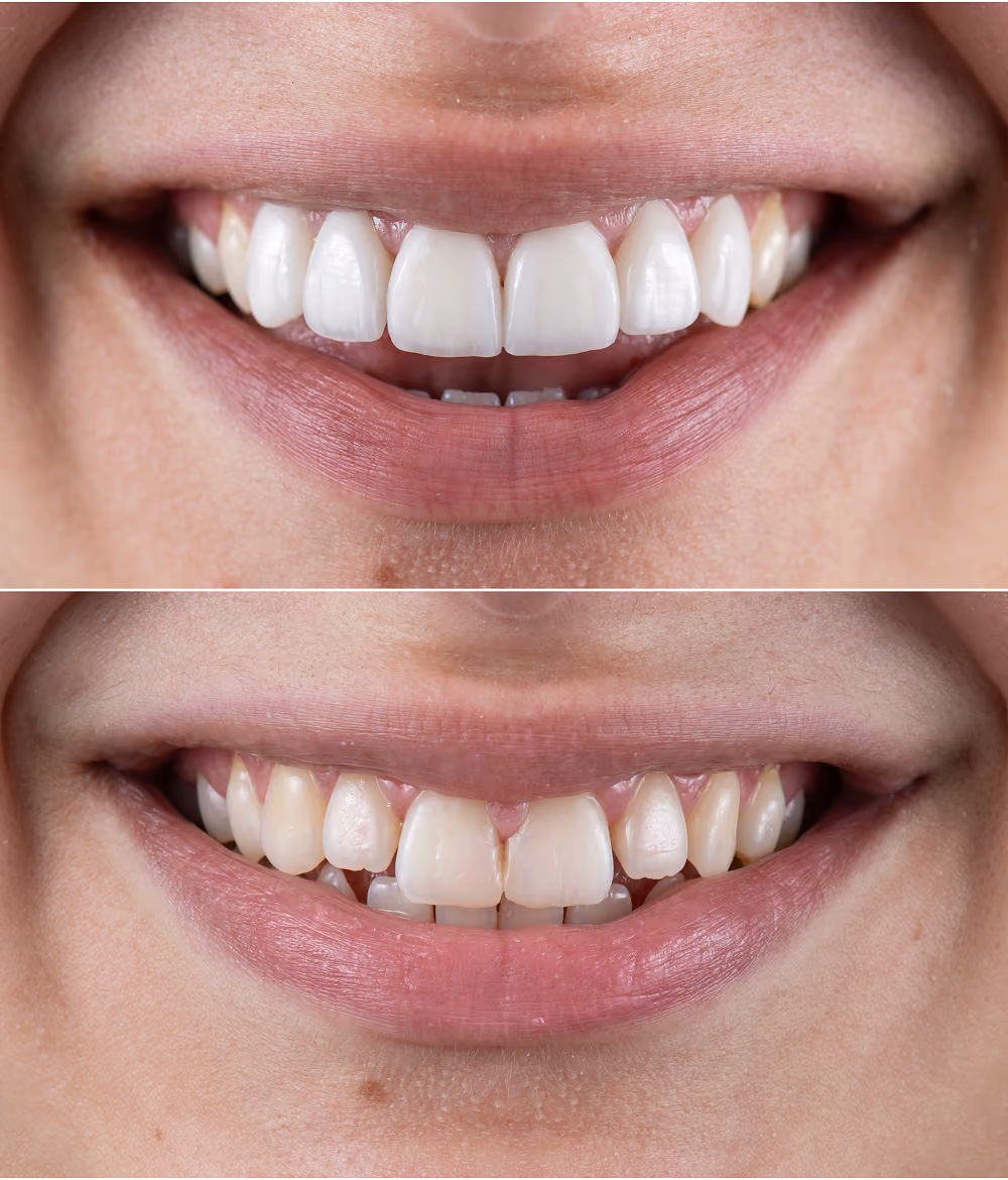 Before and after of All-on-X implants restoring a complete upper and lower smile