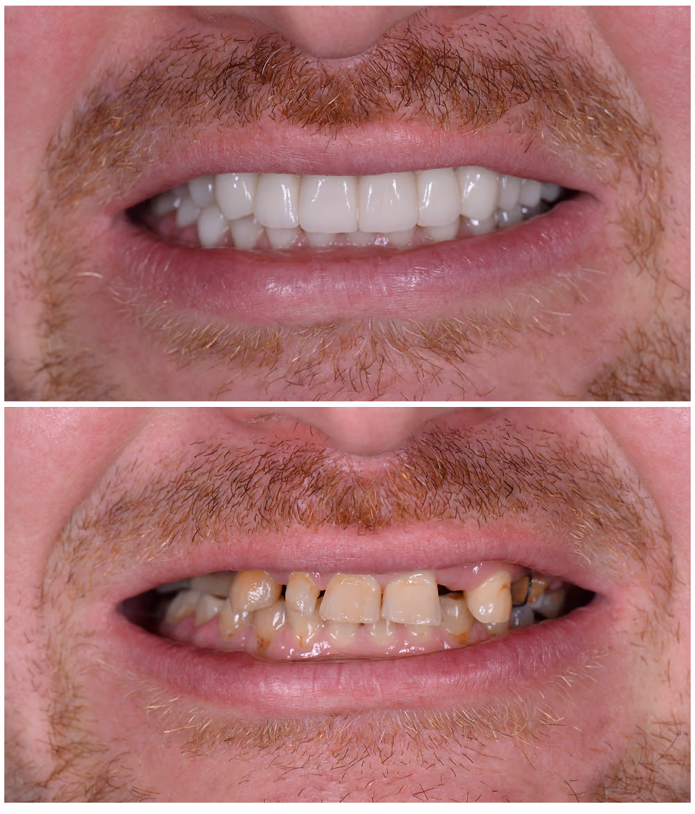 Close-up before and after of a full-arch dental implant restoration at Restore Dental Implant Studio