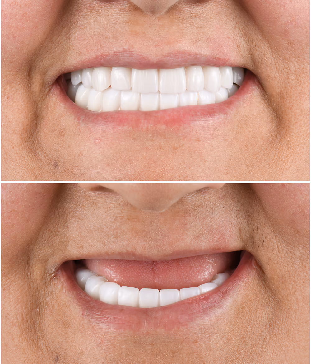 Before and after of a full-mouth implant restoration showing an even, natural-looking smile
