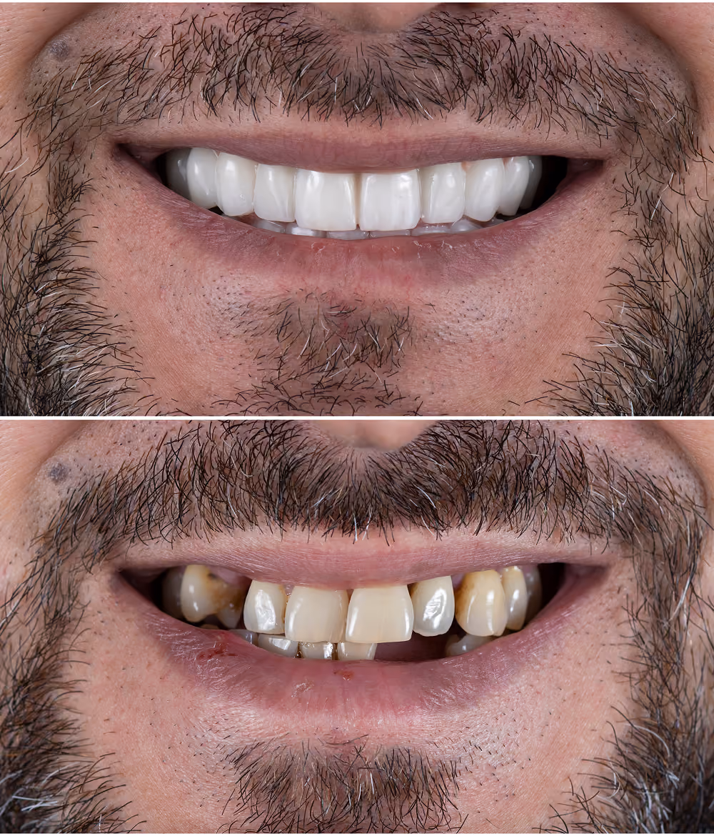 Smile before and after replacing failing upper teeth with implant-supported teeth in Las Vegas