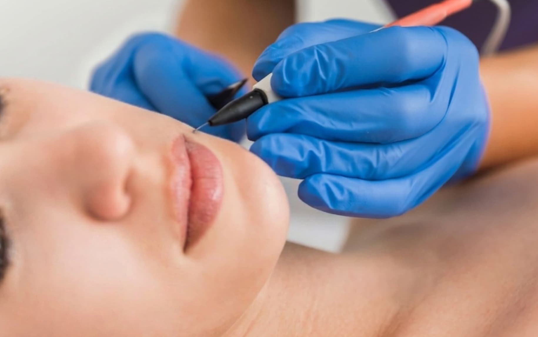 Elektroepilation