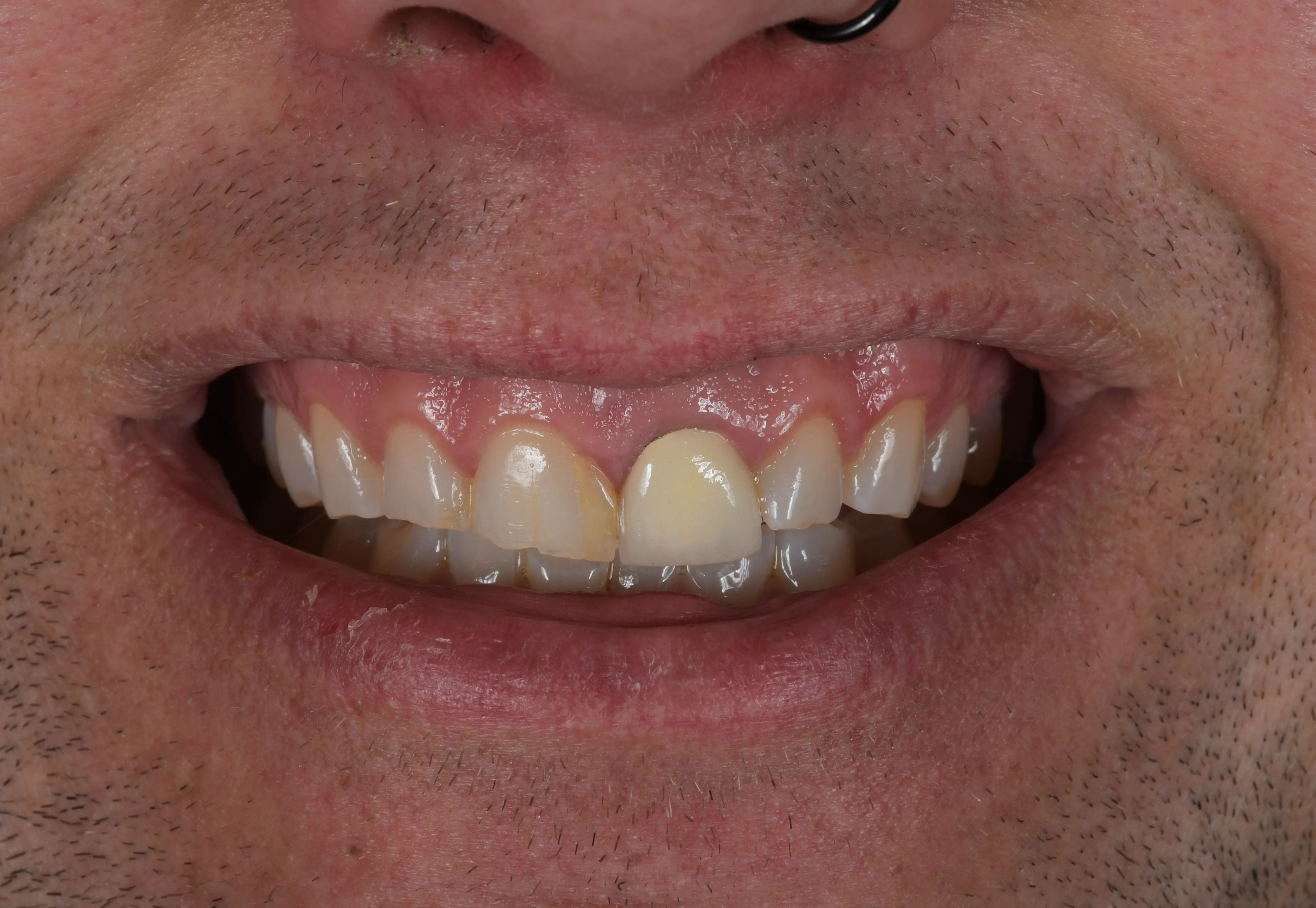 Completed smile restoration result — New Look Smile patient, Antalya