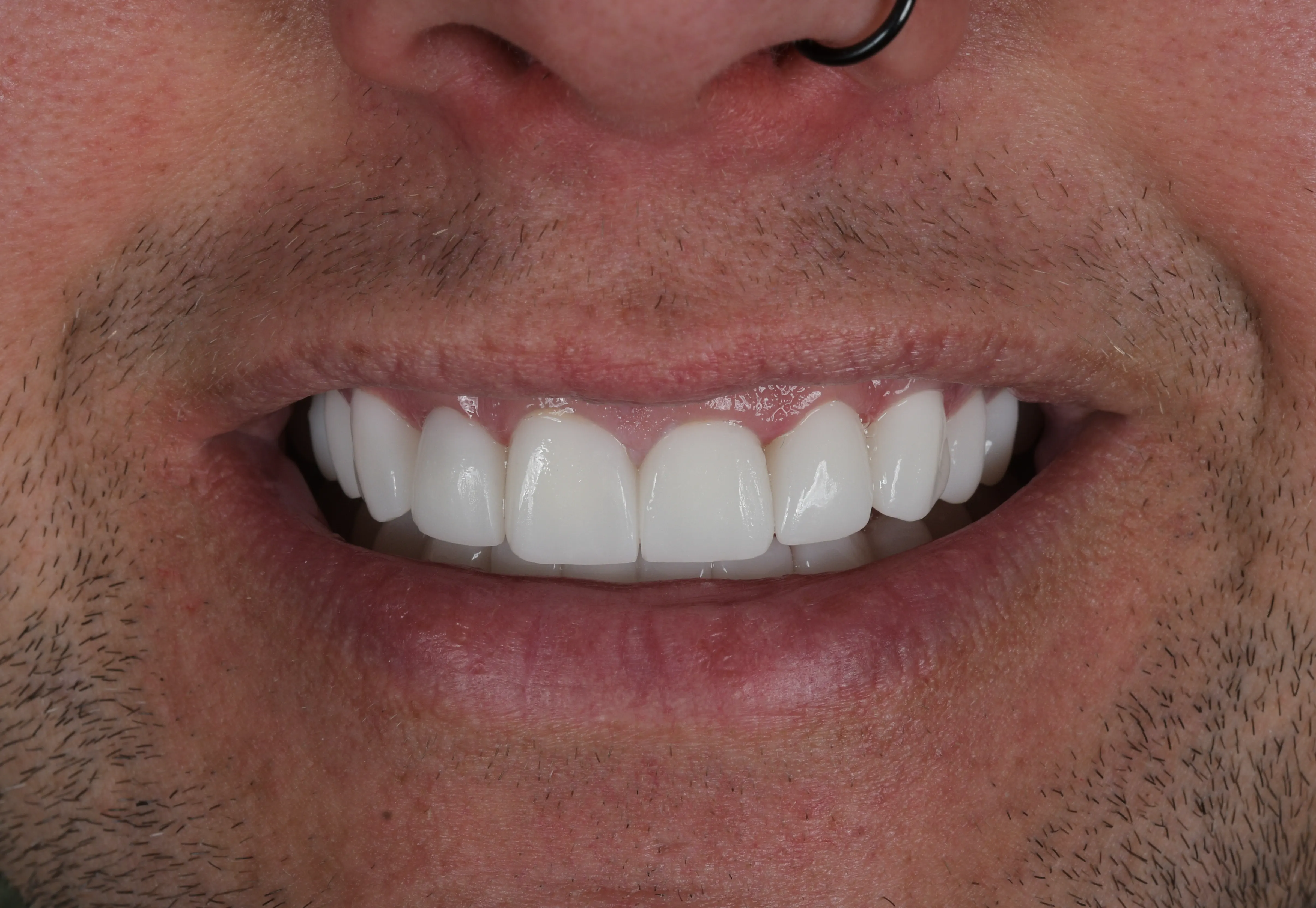 Completed smile makeover result — New Look Smile patient, Antalya