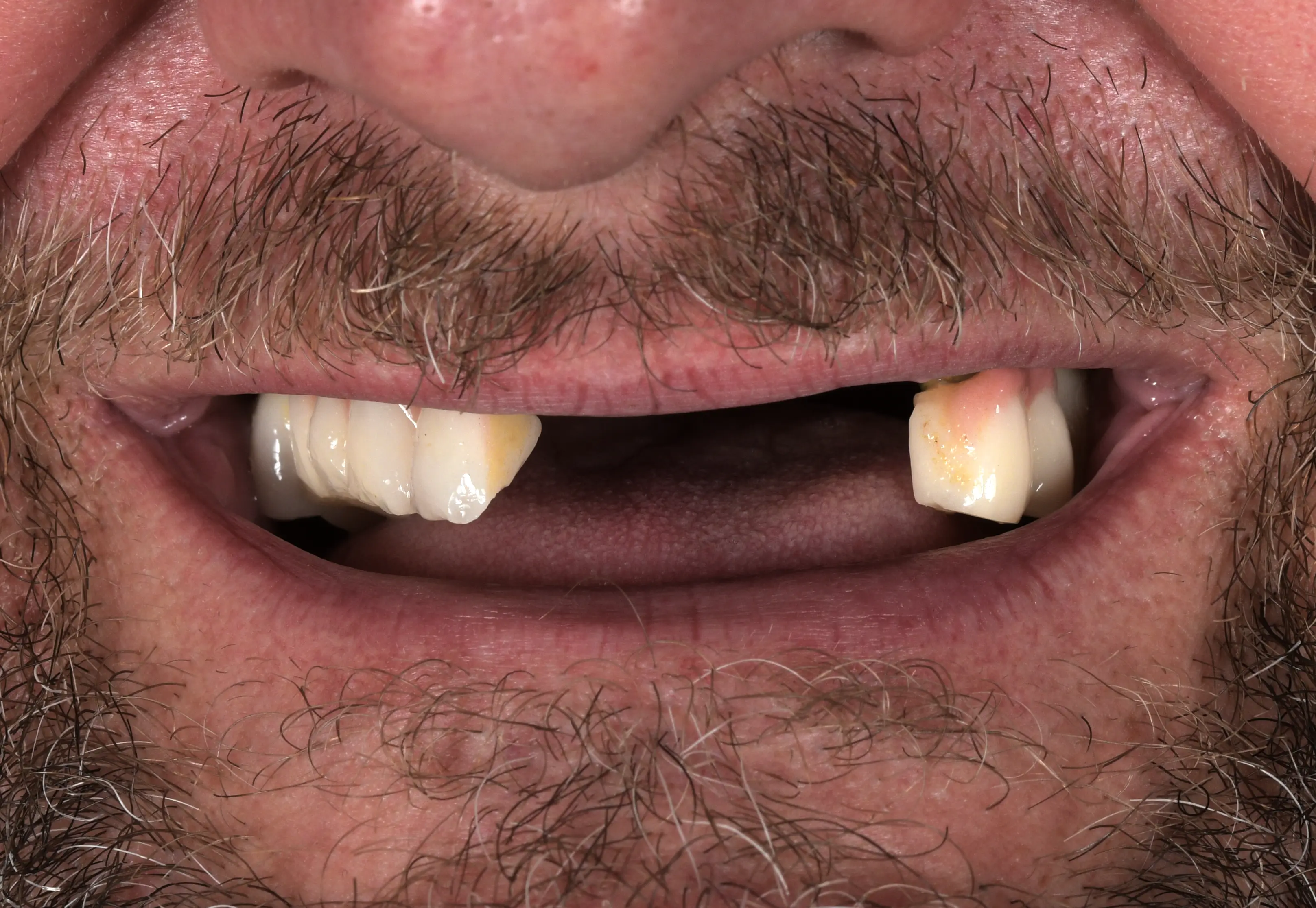Completed veneer result at our Antalya partner clinic — published with patient consent