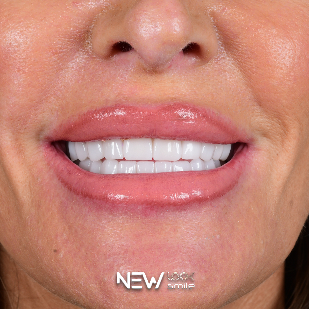 Dental implant treatment at our Antalya partner clinic
