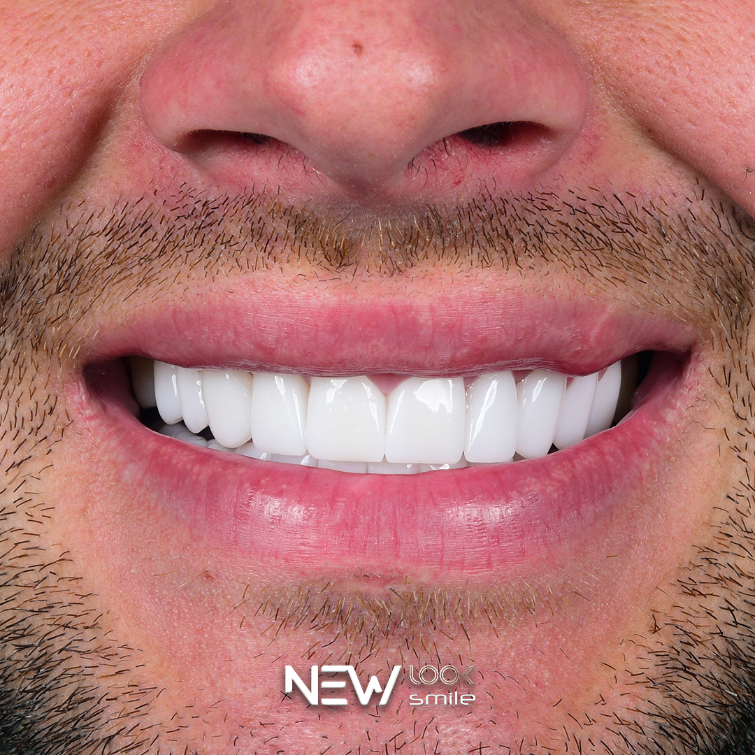 All-on-six full arch restoration