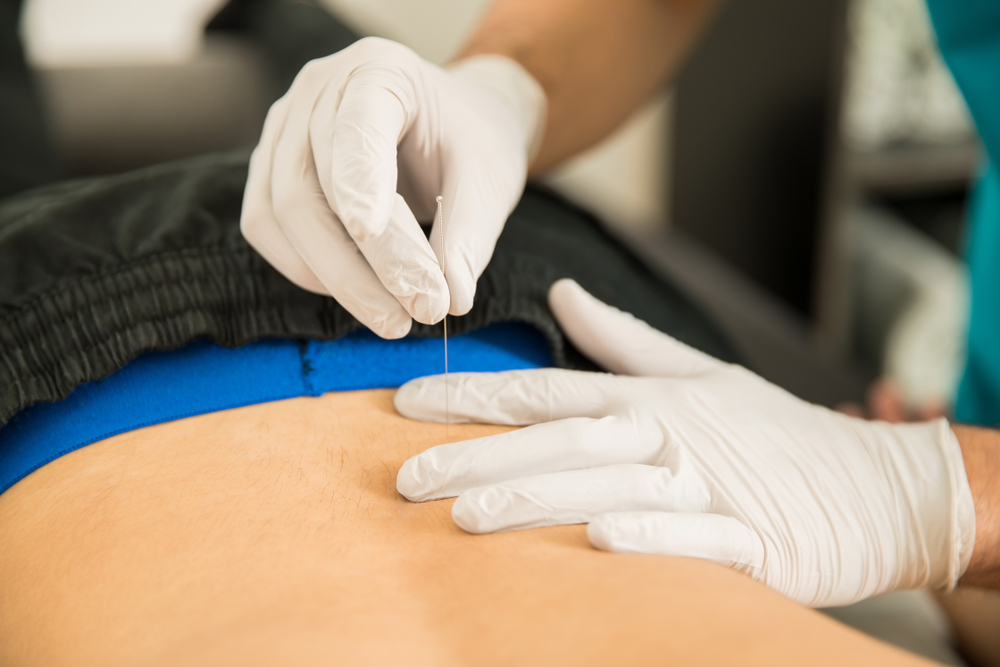 What is Dry Needling? How does it work?