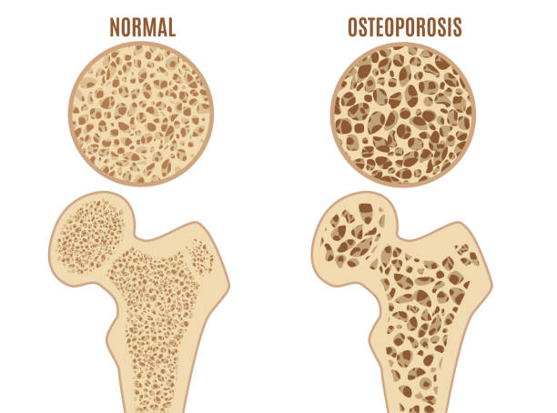 Can Pilates Increase Bone Density?
