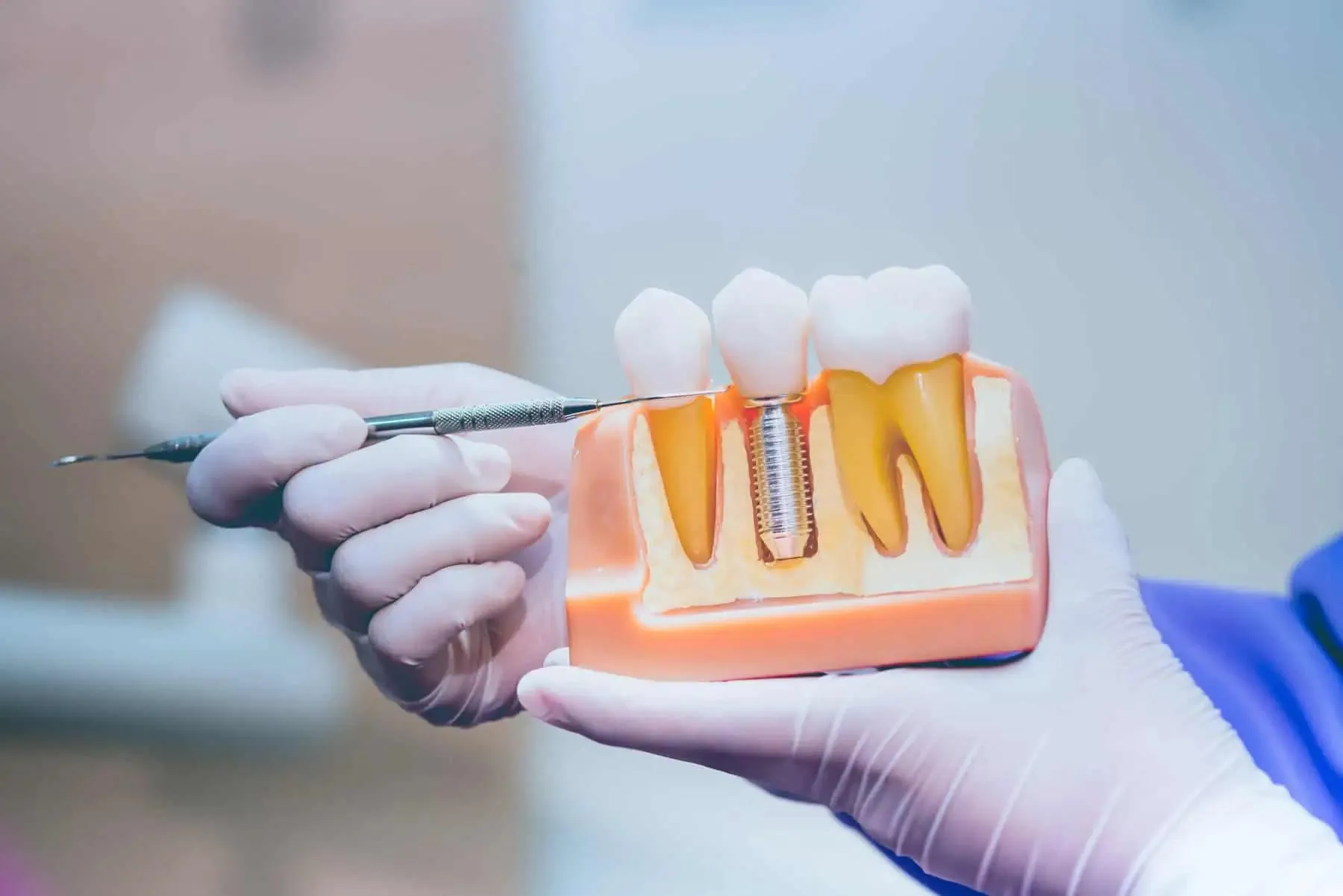 Hand wearing gloves holding dental model showing a tooth implant and natural teeth with dental tool.